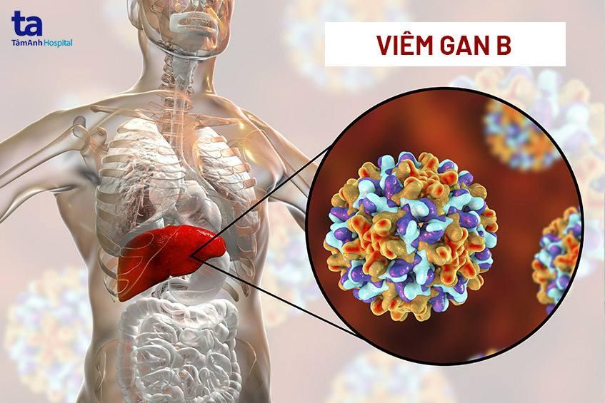 Viêm gan B: Nguyên nhân, triệu chứng, chẩn đoán và phòng ngừa