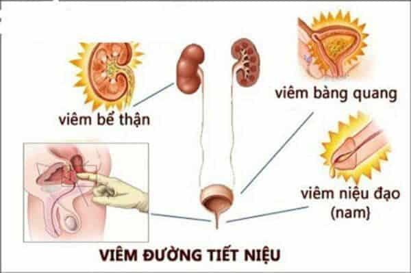 Viêm đường tiết niệu: Nguyên nhân, triệu chứng, cách điều trị.