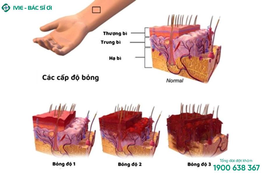 11+ Cách làm giảm đau rát khi bị bỏng tại nhà nhanh chóng