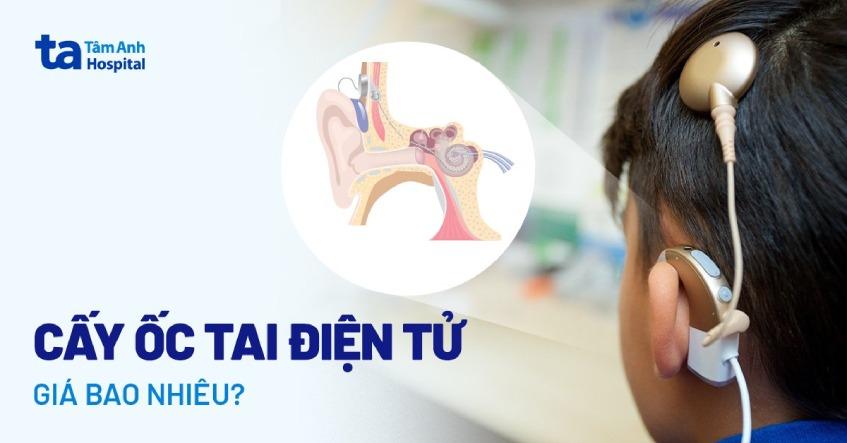 Chi phí cấy ốc tai điện tử bao nhiêu? Cách chăm sóc sau phẫu thuật