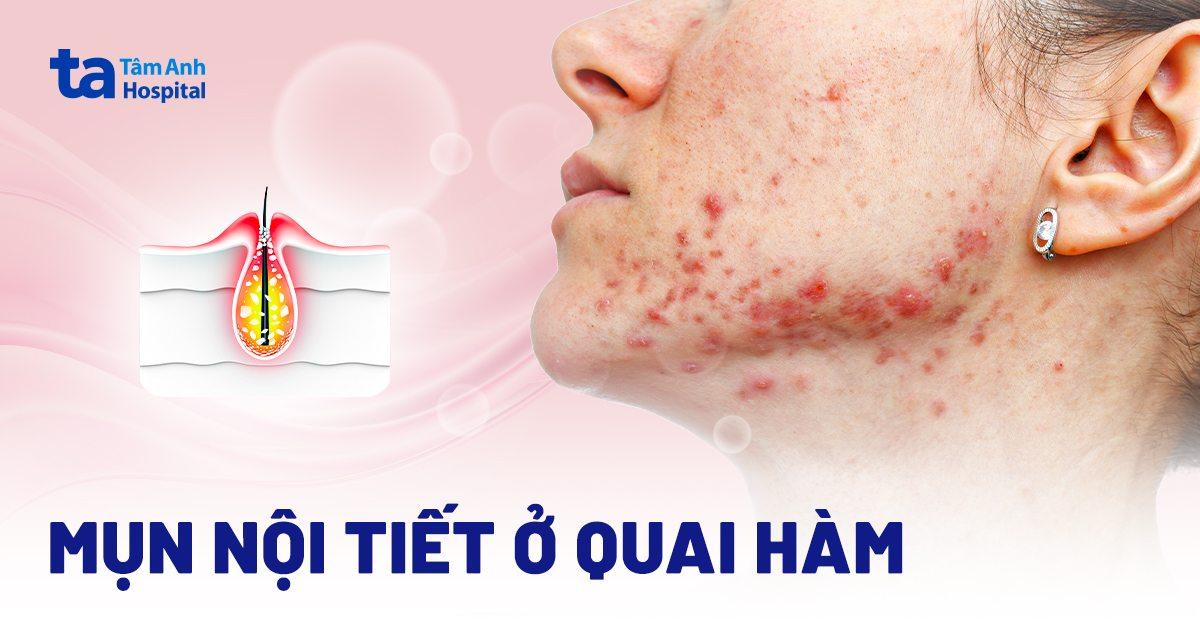 Mụn mọc quanh miệng phản ánh điều gì đối với sức khỏe?