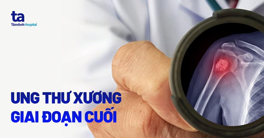 Ung thư xương giai đoạn cuối sống được bao lâu? Có biểu hiện gì?