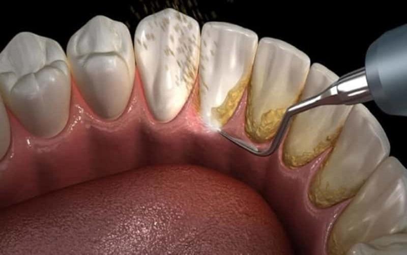 Cao răng tự vỡ liệu có nguy hiểm hay không?